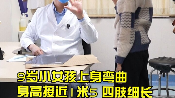 Gadis 9 tahun setinggi 1,5 meter dengan anggota tubuh panjang dan langsing menderita Sindrom Marfan