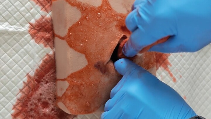 Z字型压缩纱布填塞止血示范