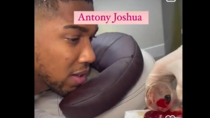 Anthony Joshua gets cupping — that blood clot looks good enough to cook with!