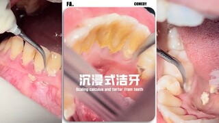 Hãy xem góc nhìn trực tiếp khi làm sạch răng👄