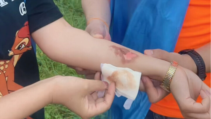 ไม่อยากให้แผลไฟไหม้ทิ้งรอยแผลเป็น? ความเชื่อโบราณแบบเก่าๆ ช่างทำร้ายคนได้ไม่น้อย!