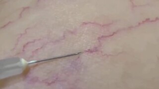 "Vascular Disappearance Surgery"