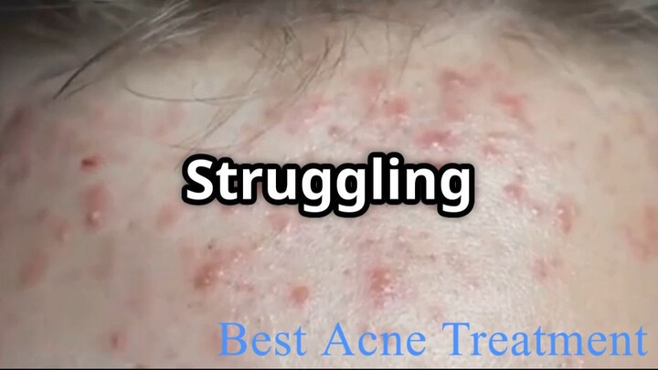 Where to Buy Accutane Online_ Trusted OnlineGenericMedicine