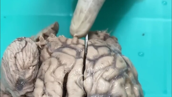 "Otak kemasukan air" bukan sekadar isapan jempol belaka—kalau tidak percaya, saya akan memotong otak