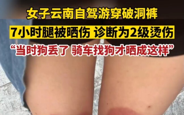Wanita yang melakukan perjalanan darat di Yunnan mengenakan celana berlubang, kaki terbakar sinar ma