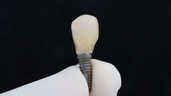 implante dentário