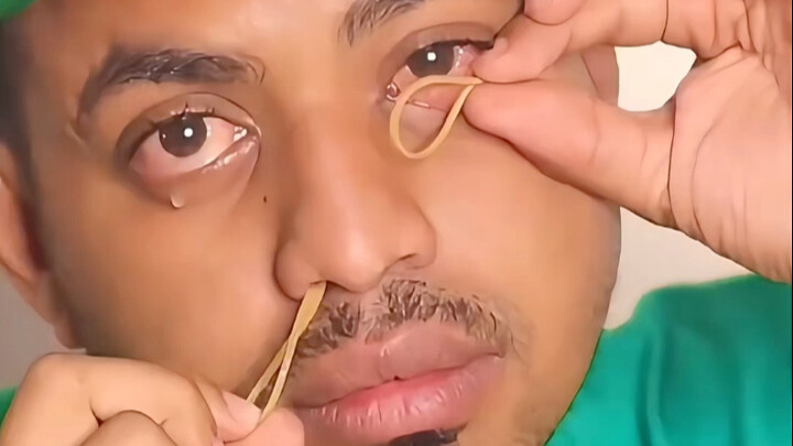 揭秘越南骗术，橡皮筋穿透眼睛！