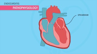 Endocarditis