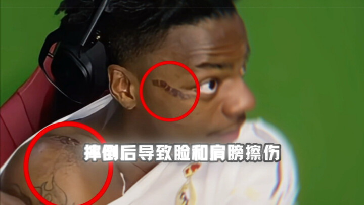 Mr. Beast is shaking with fear as he watches Hyperthyroid Brother’s livestream.