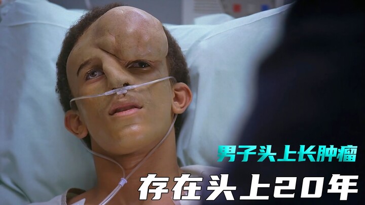 Seorang pria tumbuh tumor di kepalanya, dan kecelakaan terjadi saat tumor itu diangkat.
