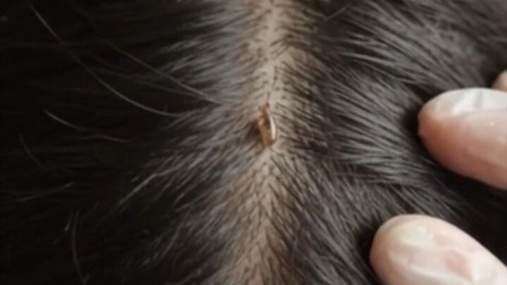 😱 Tiny Lice Removal! 🪮 | Satisfying ASMR