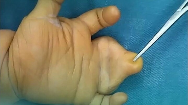 Lúc phẫu thuật, bé chỉ mới 9 tháng tuổi; sau 3 năm, bé đã có thể trò chuyện với tôi rồi!