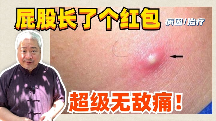 【ศาสตราจารย์ด้านโรคผิวหนัง】ก้นขึ้นตุ่ม เจ็บสุดๆ ทำยังไงดี?