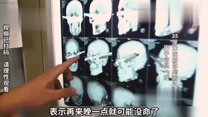 Ayah buruh migran tertusuk tulang baja 35 cm di kepala, dokter: Kalau sedikit lebih lama lagi, dia p