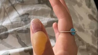 网友记录自己二级烧伤的手指，一个月的变化...这么大的水泡，她是怎么忍住不戳破的