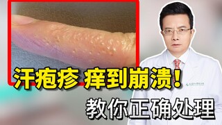 Dyshidrotic eczema causes an excruciating itch! Stop scratching—here's how doctors recommend you han