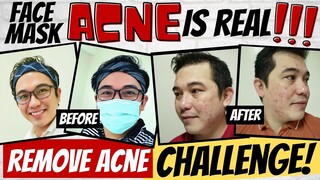 [INT'L SUB] REMOVE ACNE CHALLENGE l FACE MASK ACNE IS REAL l PIMPLES BREAKOUT l FACIAL SKINCARE TIPS