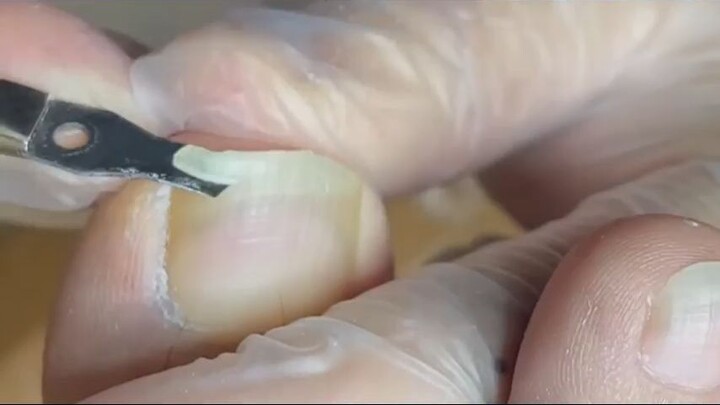 Satisfying flat toenail treament_R