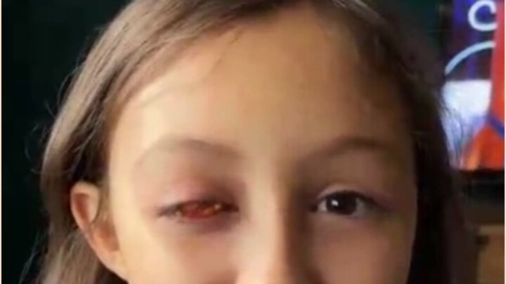 Foreign little sister with heterochromia goes wild with joy upon receiving large eye contacts!