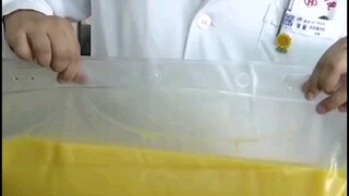 Two liters of oily fluid were dialyzed out of his blood—this man frankly said he was terrified just