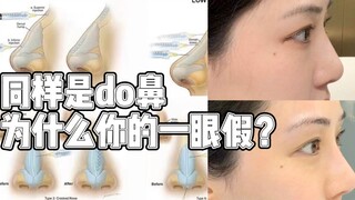 Cùng là phẫu thuật mũi, sao của bạn nhìn cứ như giả vậy?