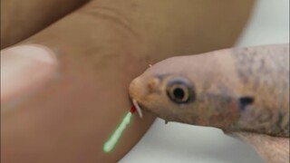 Melakukan terapi ikan membuatnya kehilangan semua jari kakinya
