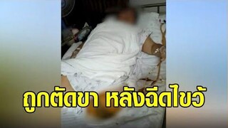 เศร้า นศสาวถูกตัดขา 1 ข้าง หลังฉีดวัคซีนไขว้เข็ม 2 แพทย์ชี้หลอดเลือดแดงอุดตันเฉียบพลัน