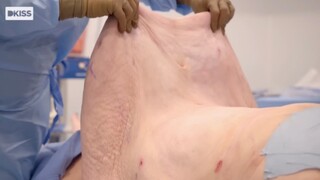 This is the belly after 4L of fat was removed