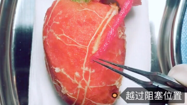 Kalau jantung sudah tidak berfungsi dengan baik, bisa dilakukan operasi by-pass jantung!