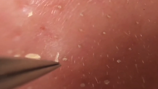 【Remove blackheads】