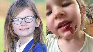 نقص الكروموسوم رقم 6 يجعل فتاة بريطانية "ثلاثية العدم": بلا إحساس بالألم، بلا شعور بالجوع، بلا شعور 