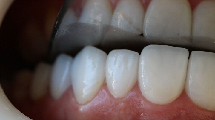 lente dental