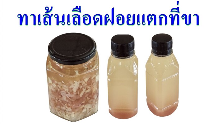 แก้เส้นเลือดขอด 🔥 สูตรคุณยายแบบโบราณ 👍 ใช้ทุกวันขาฉันสวยขึ้น