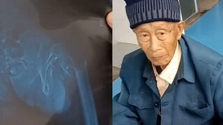 94岁爷爷打架打到住院，呆坐轮椅面无表情：竟然输给了85岁小伙子