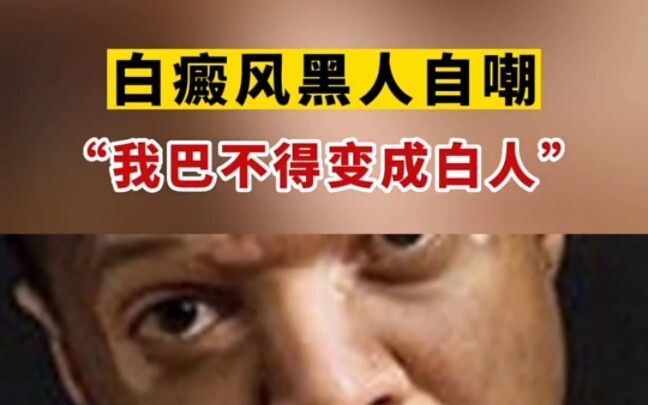 โรคด่างขาวในคนผิวดำ: “เป็นคนผิวขาว? แค่ฝันไว้!”