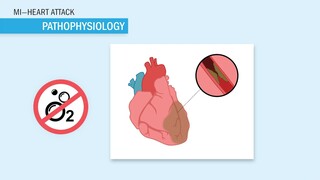 Myocardial Infarction