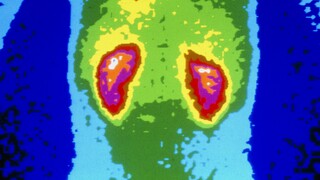 This is what happened to a man's kidneys after he took 1,176 ibuprofen tablets in one month.