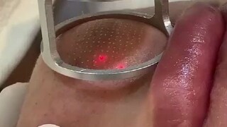 Tia laser phân đoạn có khả năng "khảm hóa" da trông khá thú vị~