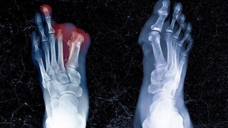 A student ate his roommate's leftover noodles, and this is what happened to his limbs.