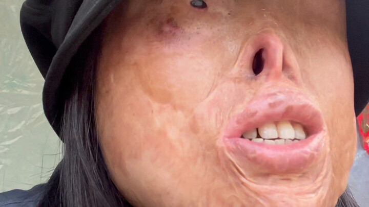 Why did my ex-husband throw acid on my face?