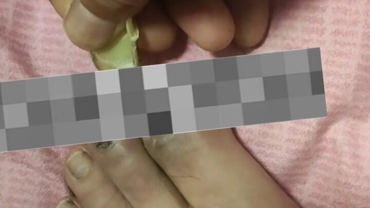 Having an ingrown toenail is so painful! I told it to heal, but I’m going to pull it out anyway—let’