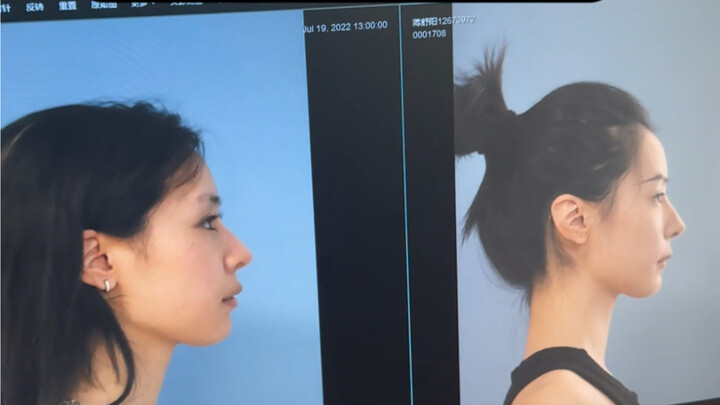 Tháo niềng răng rồi!!