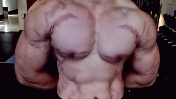 Mencekam Dunia Binaraga: “Nyanyian Kowloon” – Stretch Mark Terparah di Dunia, Kulit Seluruh Tubuh Ro