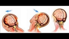 Patología craneocerebral