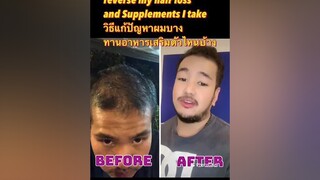 hairlosssolutions hairlossremedy hairlossjourney ผมร่วง แก้ผมร่วง แก้ผมร่วงผมบาง hairlosstreatment แก้ผมบาง ผมบาง hairlosstiktok ภาษาอังกฤษ