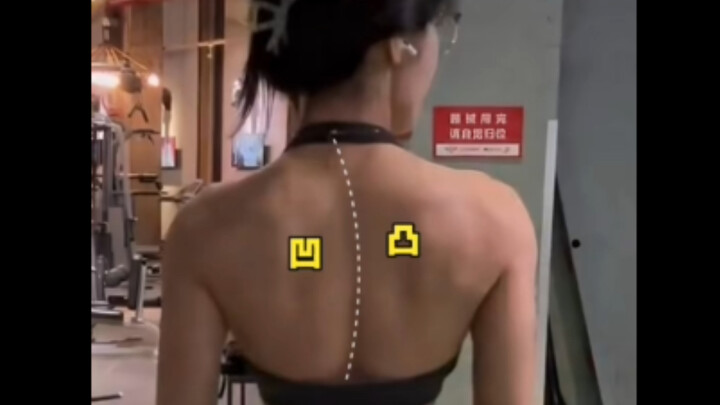 The young lady is training well. Some netizens commented that her humerus is anteriorly displaced, b