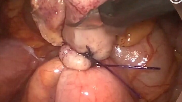 Punch a hole in your belly to remove your appendix!