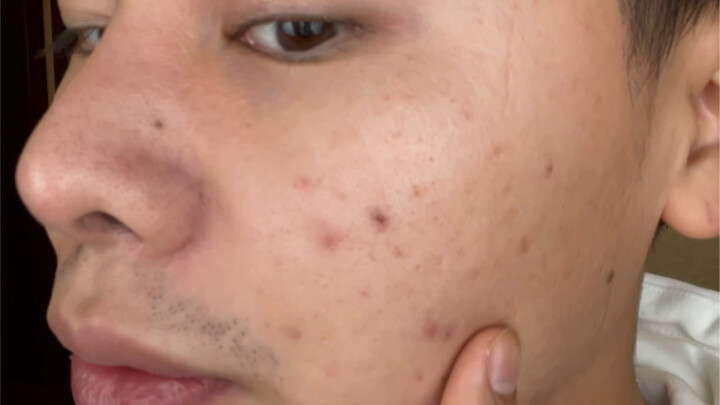 Blogger without beauty filters, entire face ruined, appearance anxiety, don't want to continue anymo