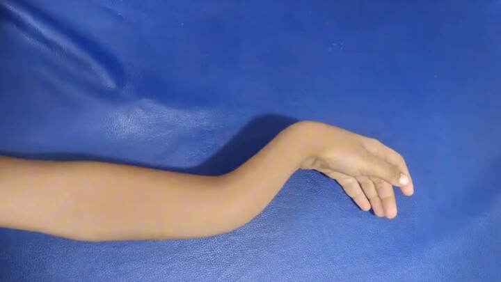 A bizarre arm fracture—see how it’s manually reduced!