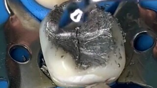 十年前的补牙材料